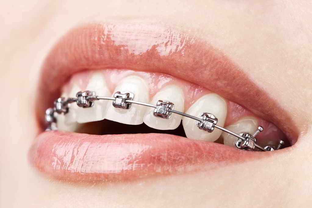 醫生常說矯正牙齒更要把牙刷好，but how？