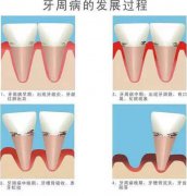 牙周病 需要終身 維護治療