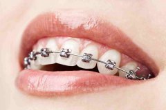 關於牙齒矯正方式，你知道幾多呢