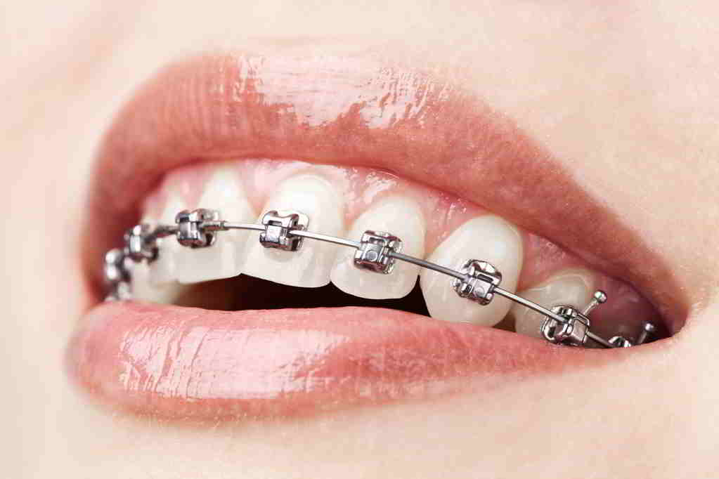 牙齒矯正方式,箍牙方法