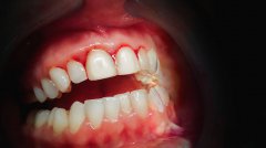牙齦出血是怎麼一回事？