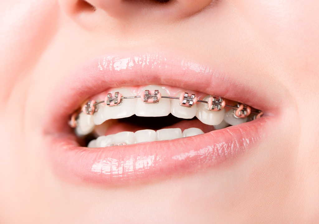 珠海牙齒矯正費用,大陸箍牙牙醫推薦