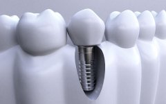 種牙成功率有幾多？如何提升種牙成功率？