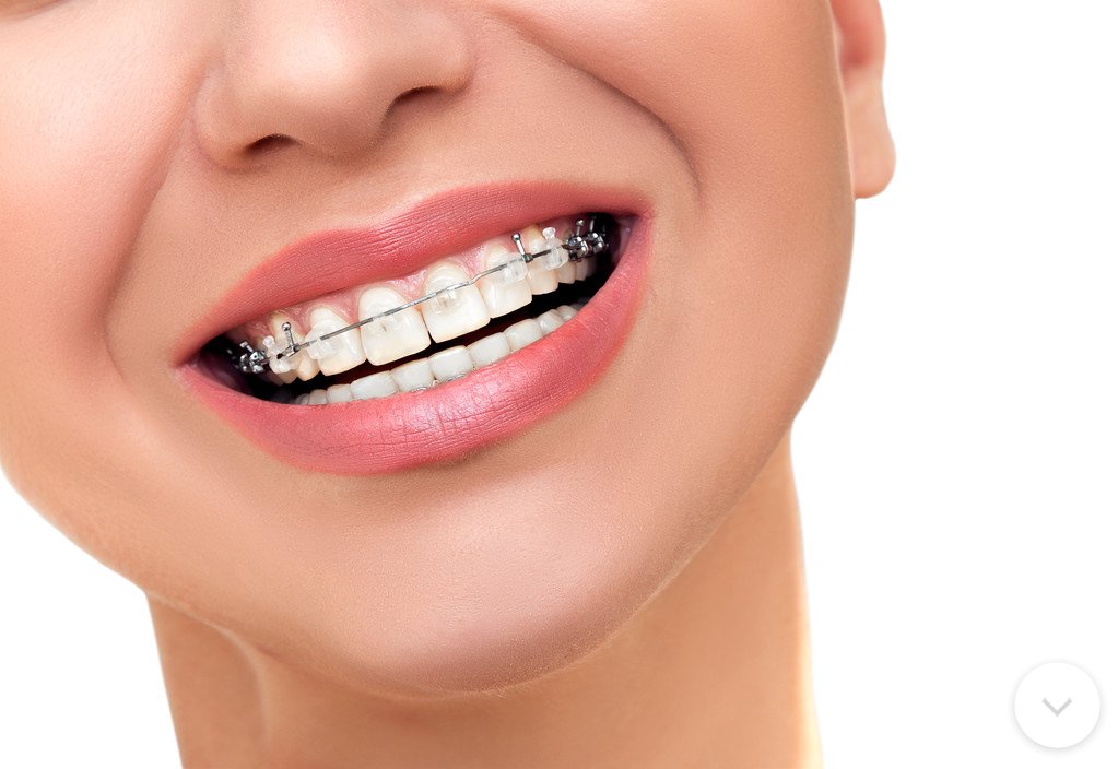 澳門齙牙矯正，“齙牙”是深覆頜還是深覆蓋？